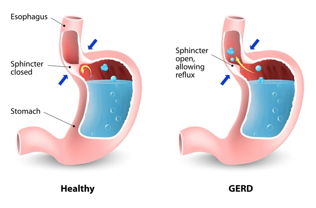 Perbedaan Kondisi Lambung Normal vs GERD (Foto:gastrohealth.com)