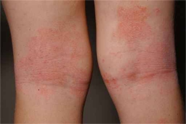 Ilustrasi Dermatitis Atopik. (Foto: bisnis.com)