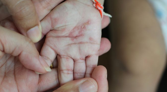 Ilustrasi seorang anak yang Skabies Berkrusta. (Sumber foto: klikdokter.com terkena