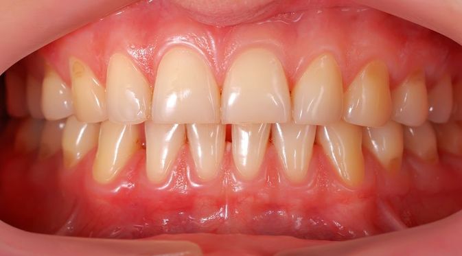 Ilustrasi resesi gingiva (Foto: klikdokter)