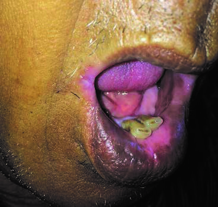 ILUSTRASI luka di sudut mulut. (Foto: Istimewa)