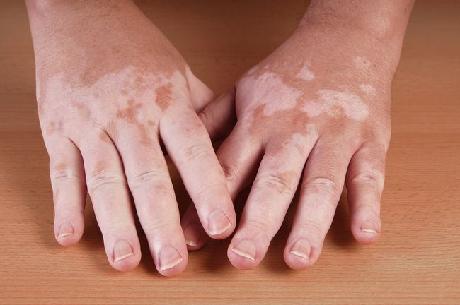 ILUSTRASI pasien vitiligo. (Foto: Istimewa)