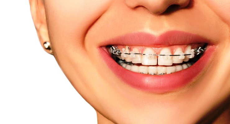 ILUSTRASI perawatan ortodontik. (Foto: Istimewa)