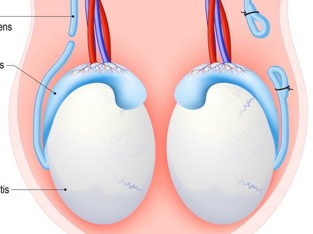 ILUSTRASI vasektomi. (Foto: klikdokter.com)