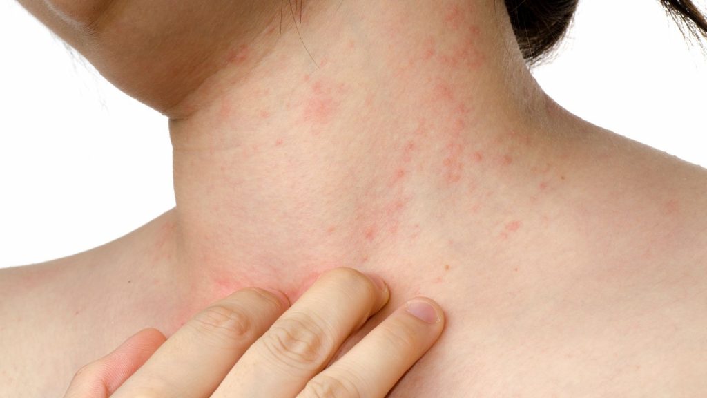 ILUSTRASI pasien psoriasis. (Foto: health.grid.com)