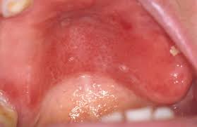 Hubungan Penyakit Tuberkulosis dan Oral Candidiasis