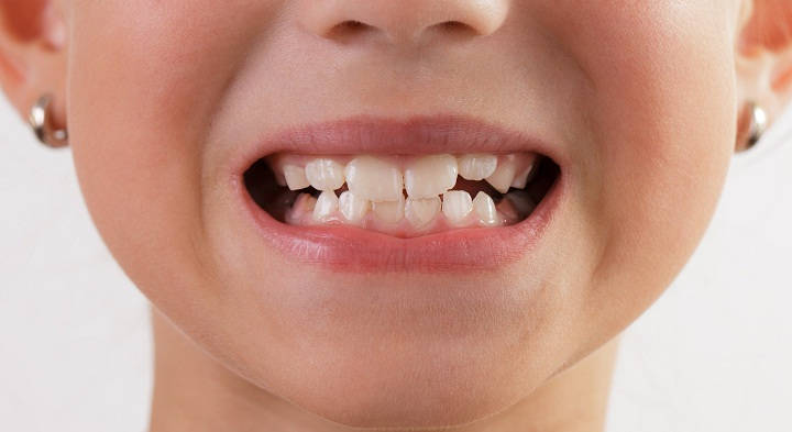 Mengatasi Dampak Kehilangan Gigi melalui Program Pengabdian Masyarakat