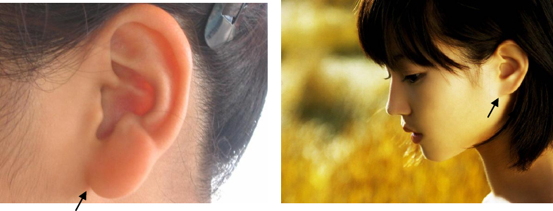 ILUSTRASI Penyakit Genetic Autosomal Resesif. (Foto: https://reader016.staticloud.net)