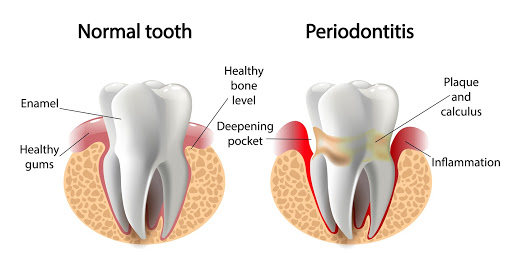 ILUSTRASI Jaringan Periodontal. (Foto: konimex.com)