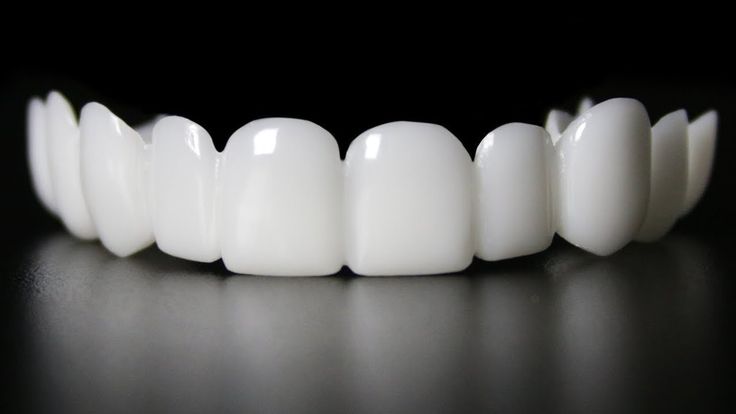 Pembuatan Snap-On Smile dengan Bahan Resin Acetyl Thermoplastic untuk Memperbaiki Gigi Hilang