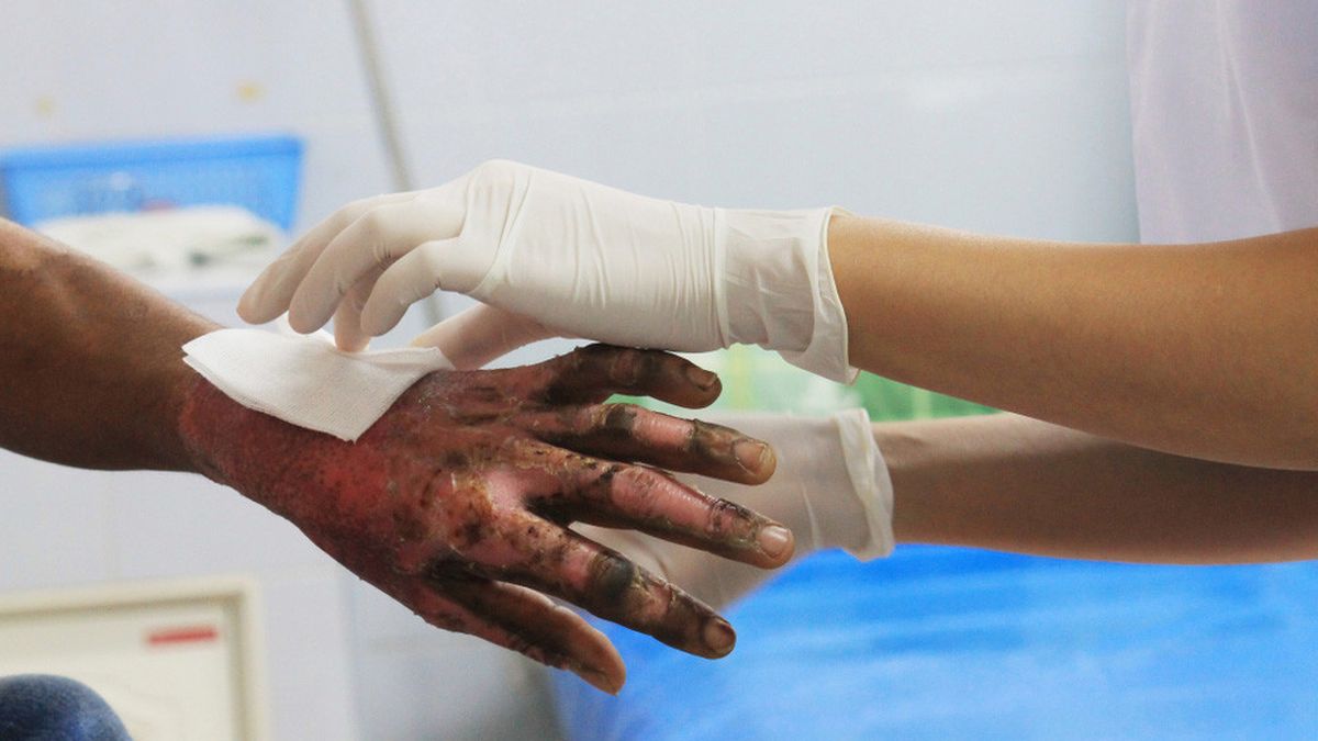 Ilustrasi Luka Bakar