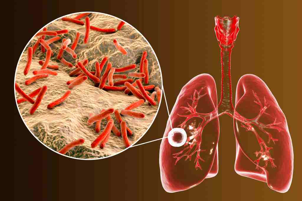 Infeksi Tuberculosis pada Serebellar Pasien Imunokompeten