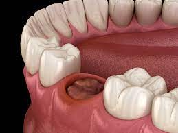 Pola Sel Osteosit pada Regeneratif Tulang Soket Gigi yang Diinduksi oleh Bahan Cangkok Tulang Hidroksiapatit Gigi Sapi