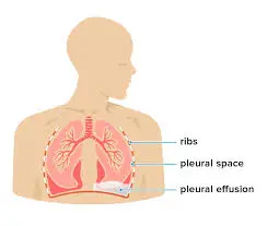 Hepatic Hydrothorax