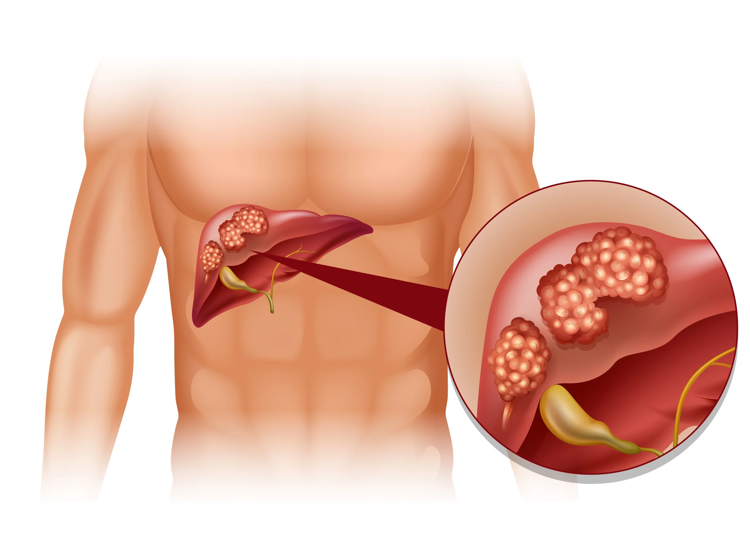 Efikasi dan Keamanan Regorafenib dan Nivolumab dalam Terapi Kanker Hepar