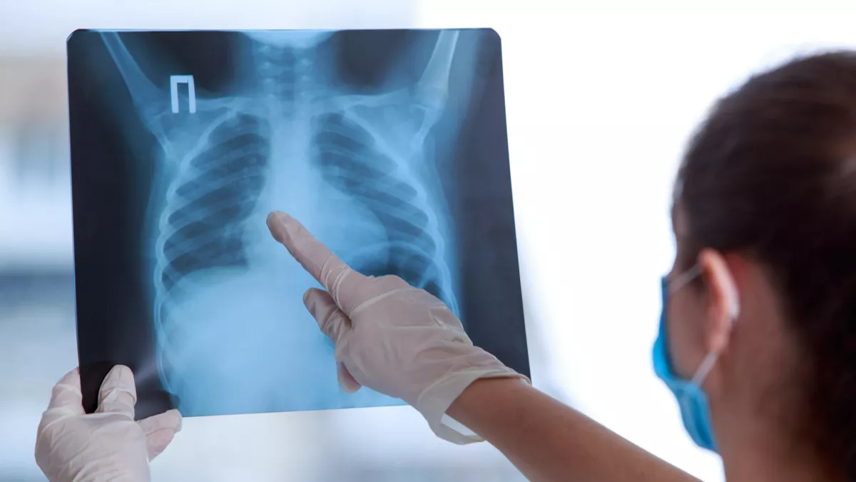 Kasus Pneumonia pada Balita Berdasarkan ASI Eksklusif, Gizi Buruk, dan Kepadatan Penduduk