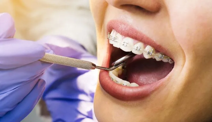Perawatan Resesi Gingiva Klas I Miller