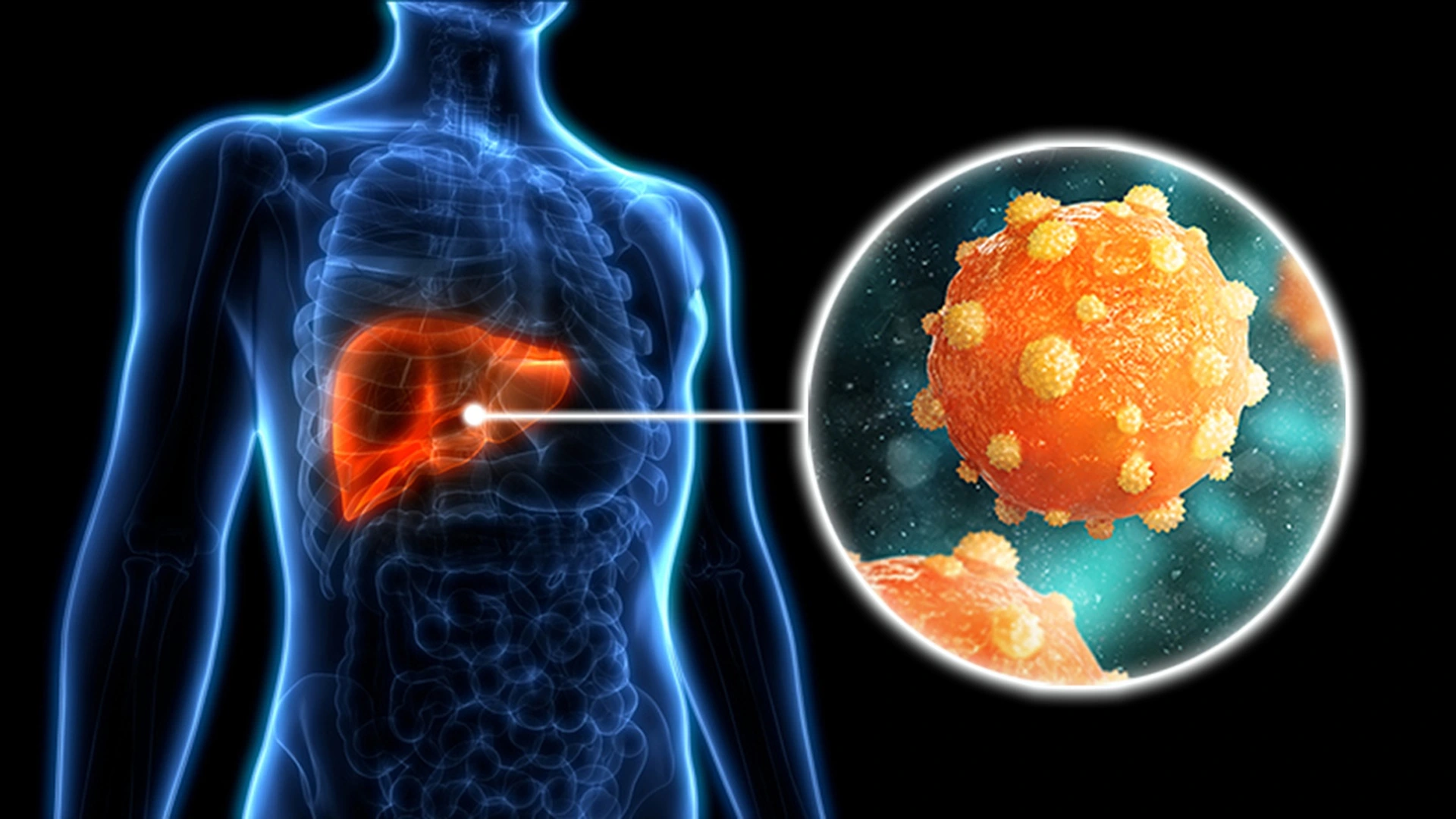 Rasio Neutrofil terhadap Limfosit pada Pasien Hepatitis B Kronis
