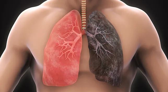 Pendekatan Holistik dalam Mengatasi Dekompensasi Cor Pulmonale Akut