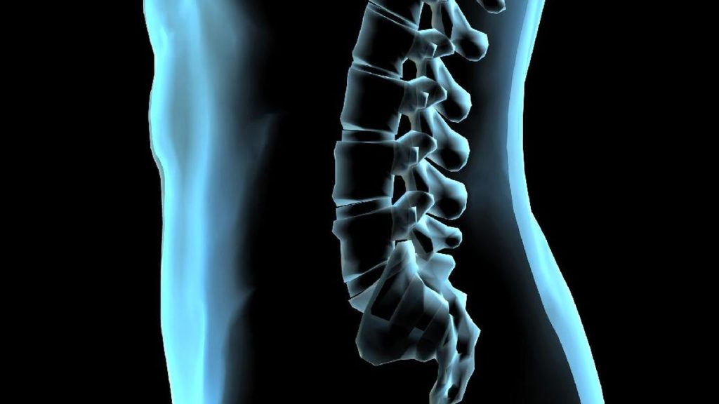 Perbedaan Terapi Radiasi Tubuh Stereotaktik dan Terapi Radiasi Tubuh Konvensional dalam Menangani Kasus Kanker yang Menyebar ke Tulang Belakang