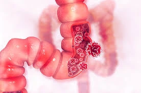 Colorectal cancer illustration (Photo: halodoc)
