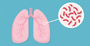 Iluistrasi Tuberkulosis (sumber: RS JDH)
