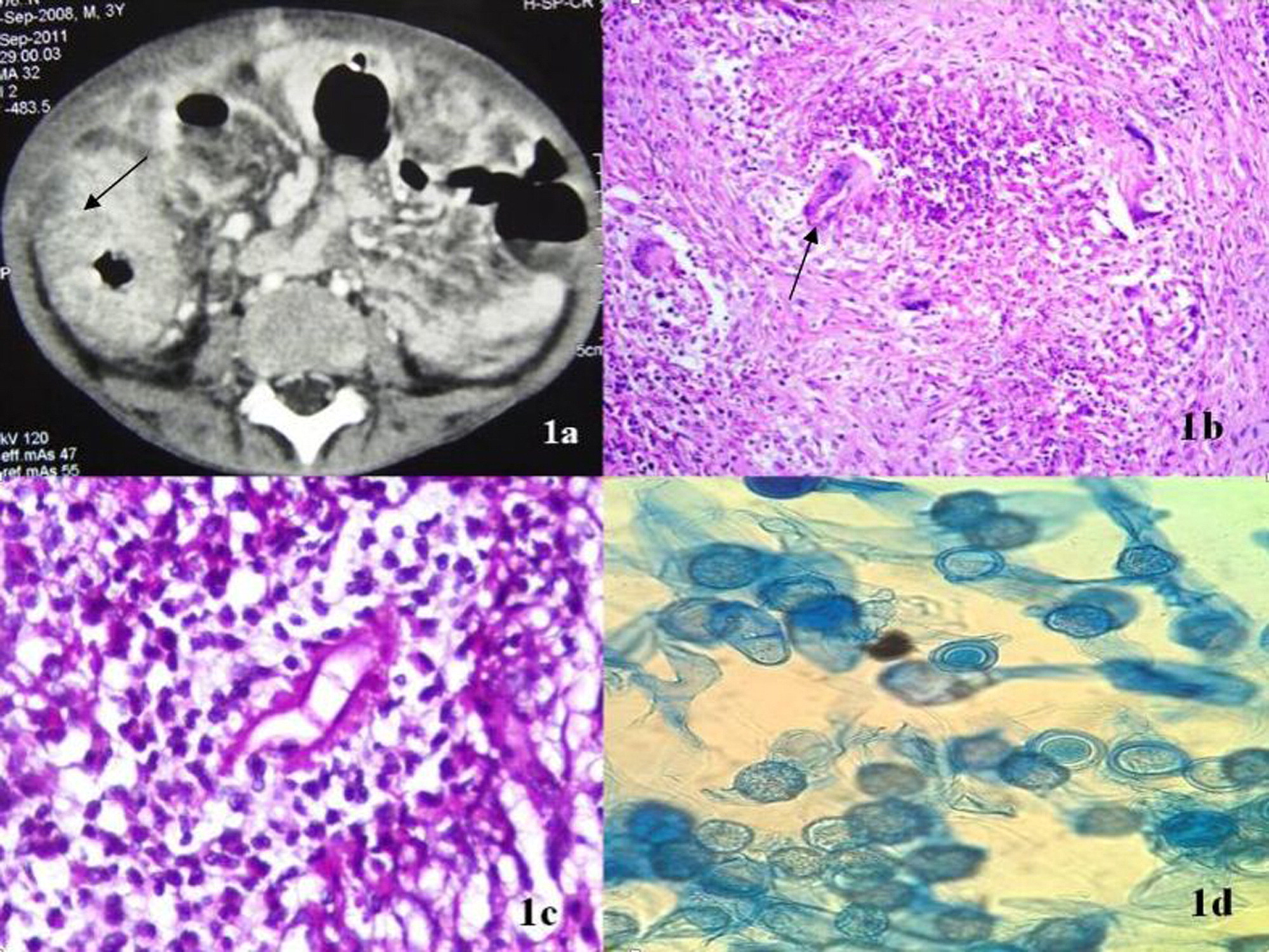 sumber: https://www.ijidonline.com/article/S1201-9712%2814%2900003-4/fulltext